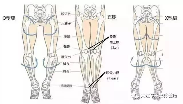 o型腿是骨头弯了?